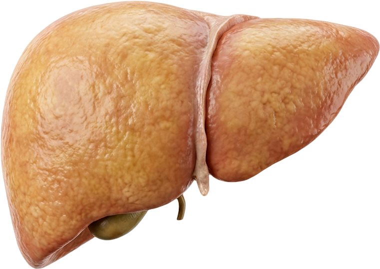 Esteatose Hepática